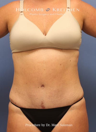Tummy Tuck Before & After Gallery - Patient 379789 - Image 2