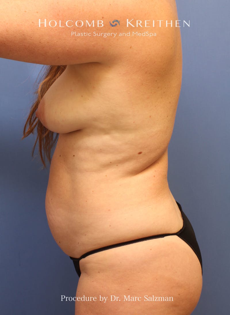Tummy Tuck Before & After Gallery - Patient 379789 - Image 5