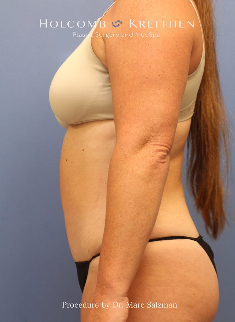Tummy Tuck Before & After Gallery - Patient 379789 - Image 6