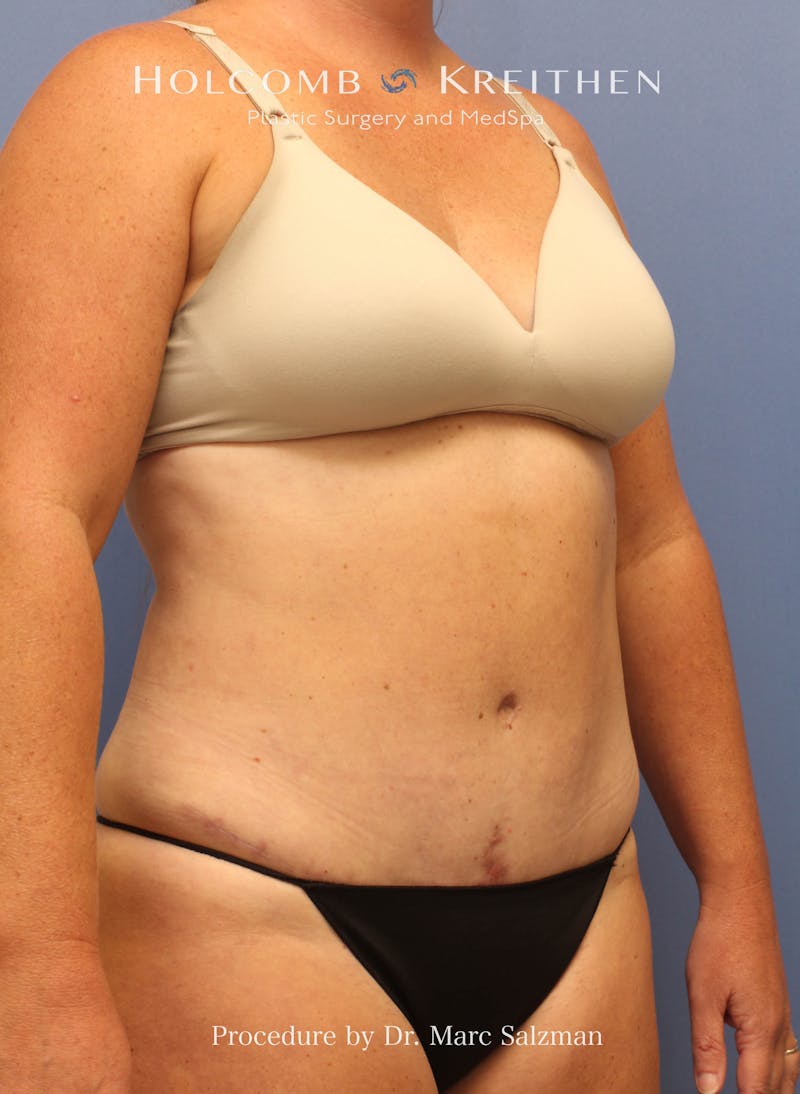Tummy Tuck Before & After Gallery - Patient 379789 - Image 8