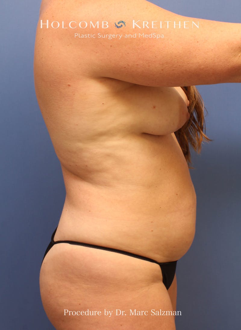 Tummy Tuck Before & After Gallery - Patient 379789 - Image 9