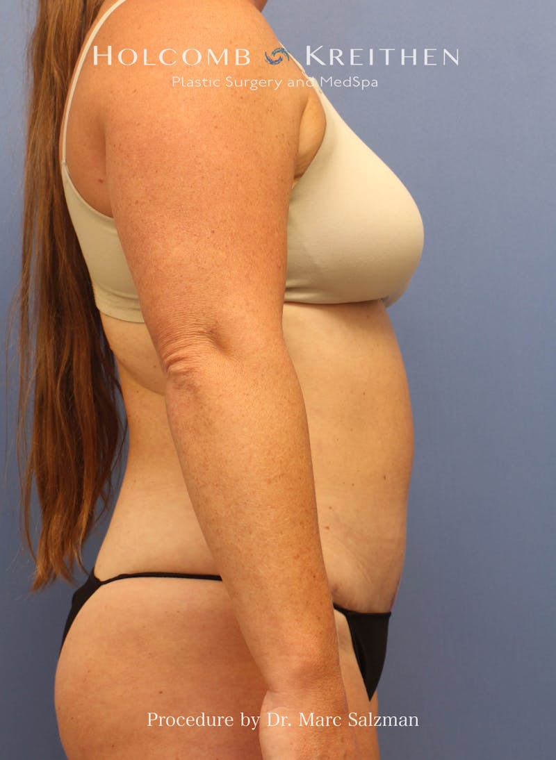Tummy Tuck Before & After Gallery - Patient 379789 - Image 10