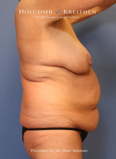 Tummy Tuck Before & After Gallery - Patient 340540 - Image 1