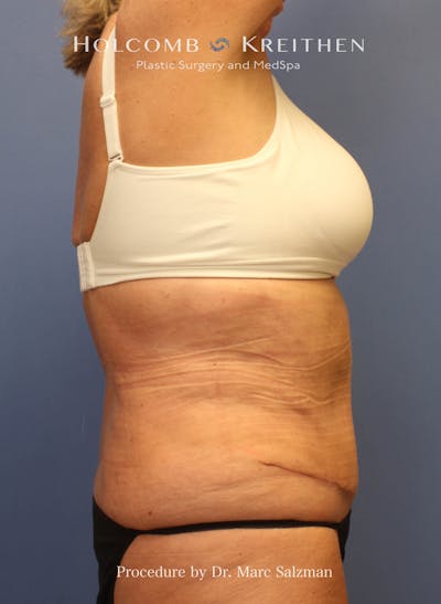 Tummy Tuck Before & After Gallery - Patient 340540 - Image 2