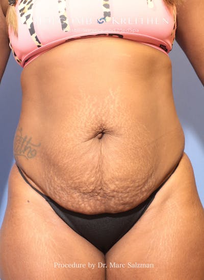 Tummy Tuck Before & After Gallery - Patient 392316 - Image 1