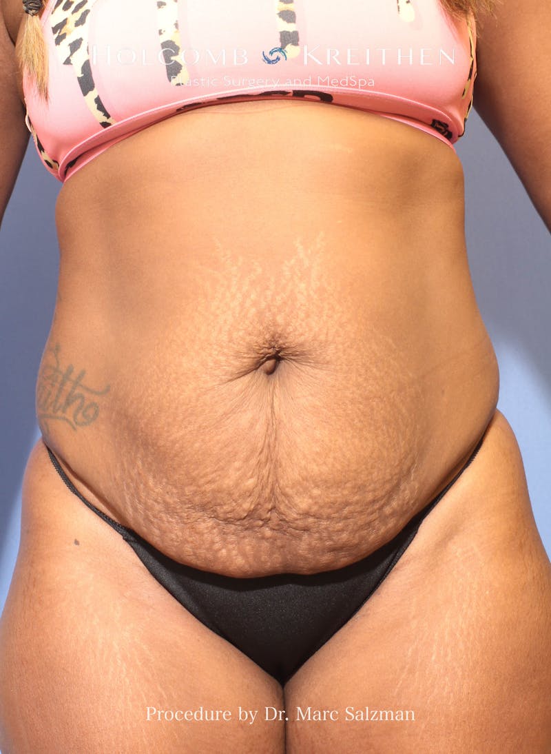 Tummy Tuck Before & After Gallery - Patient 392316 - Image 1