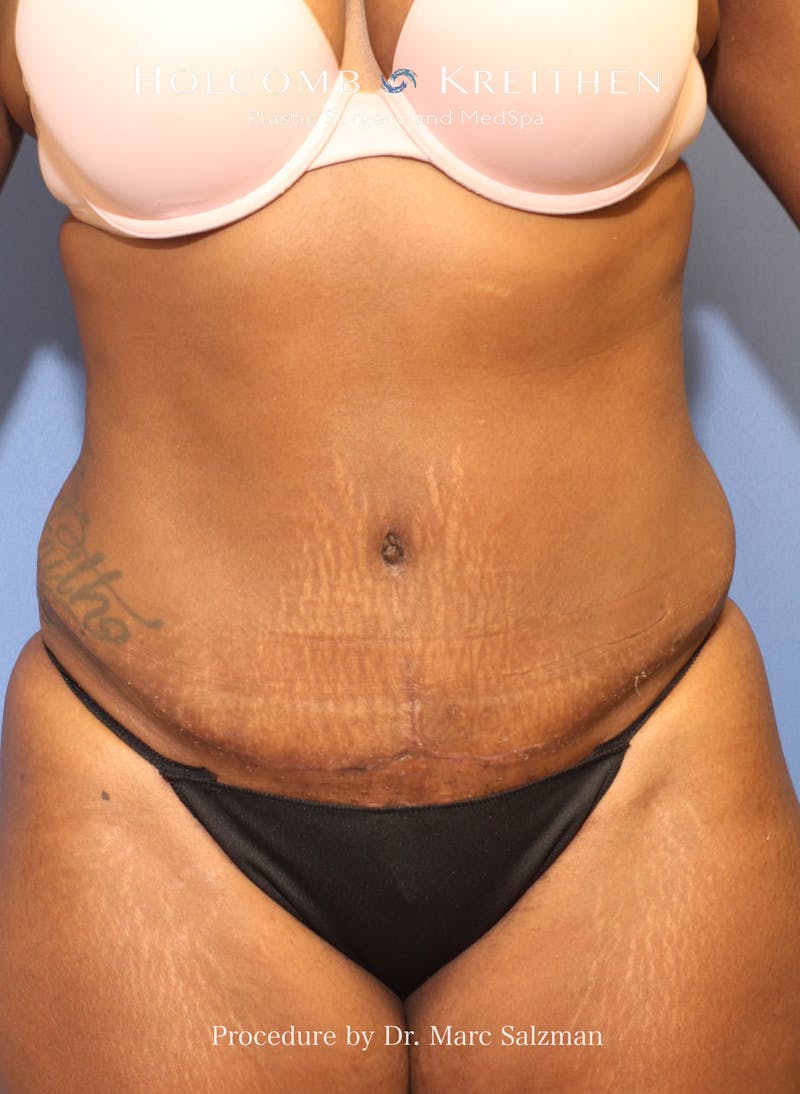 Tummy Tuck Before & After Gallery - Patient 392316 - Image 2