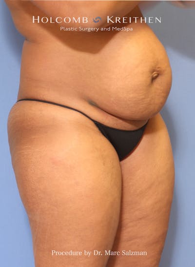 Tummy Tuck Before & After Gallery - Patient 309957 - Image 1