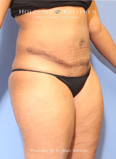Tummy Tuck Before & After Gallery - Patient 309957 - Image 2