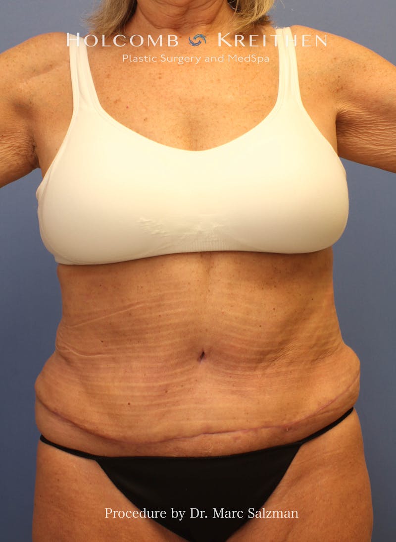 Tummy Tuck Before & After Gallery - Patient 416921 - Image 2