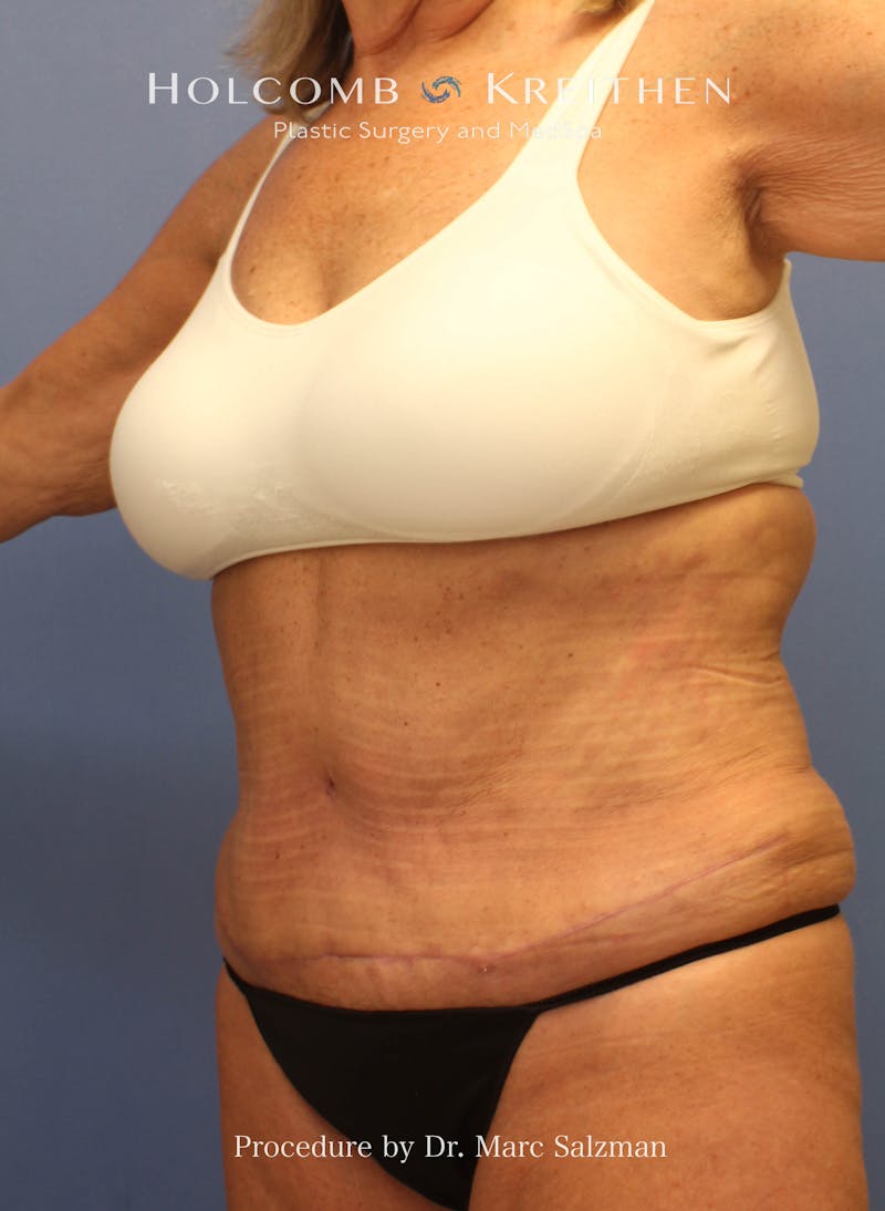 Tummy Tuck Before & After Gallery - Patient 416921 - Image 4