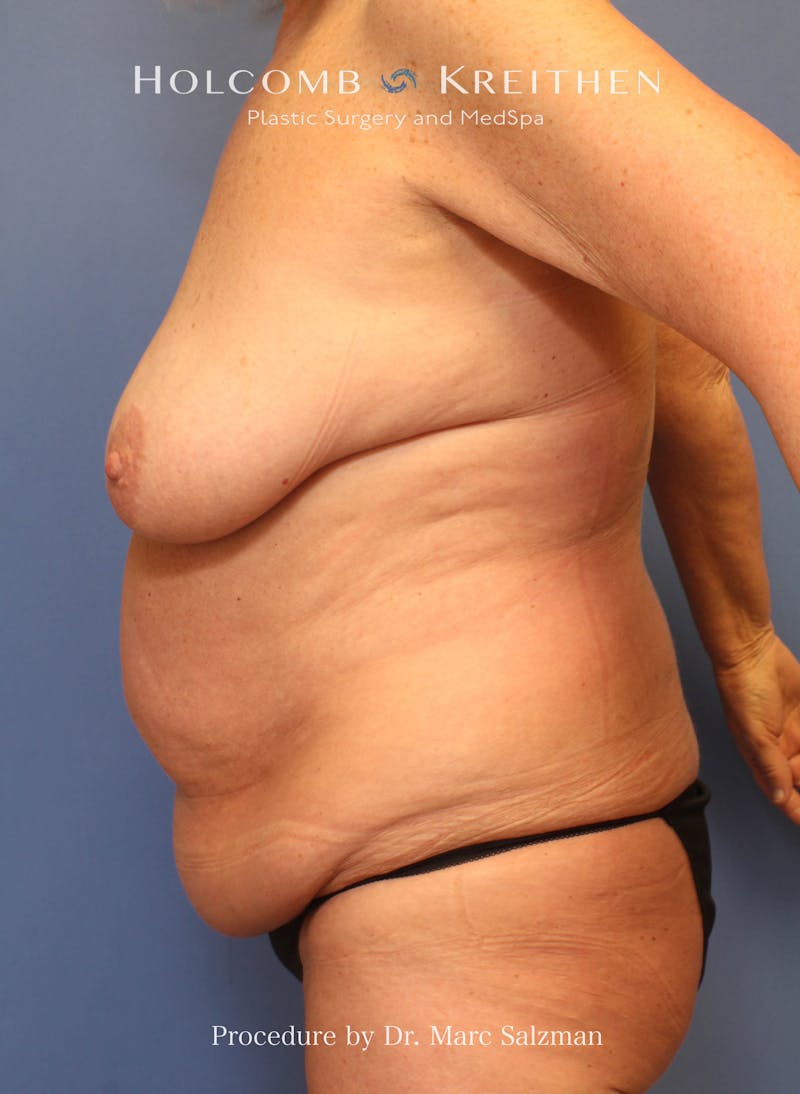 Tummy Tuck Before & After Gallery - Patient 416921 - Image 5