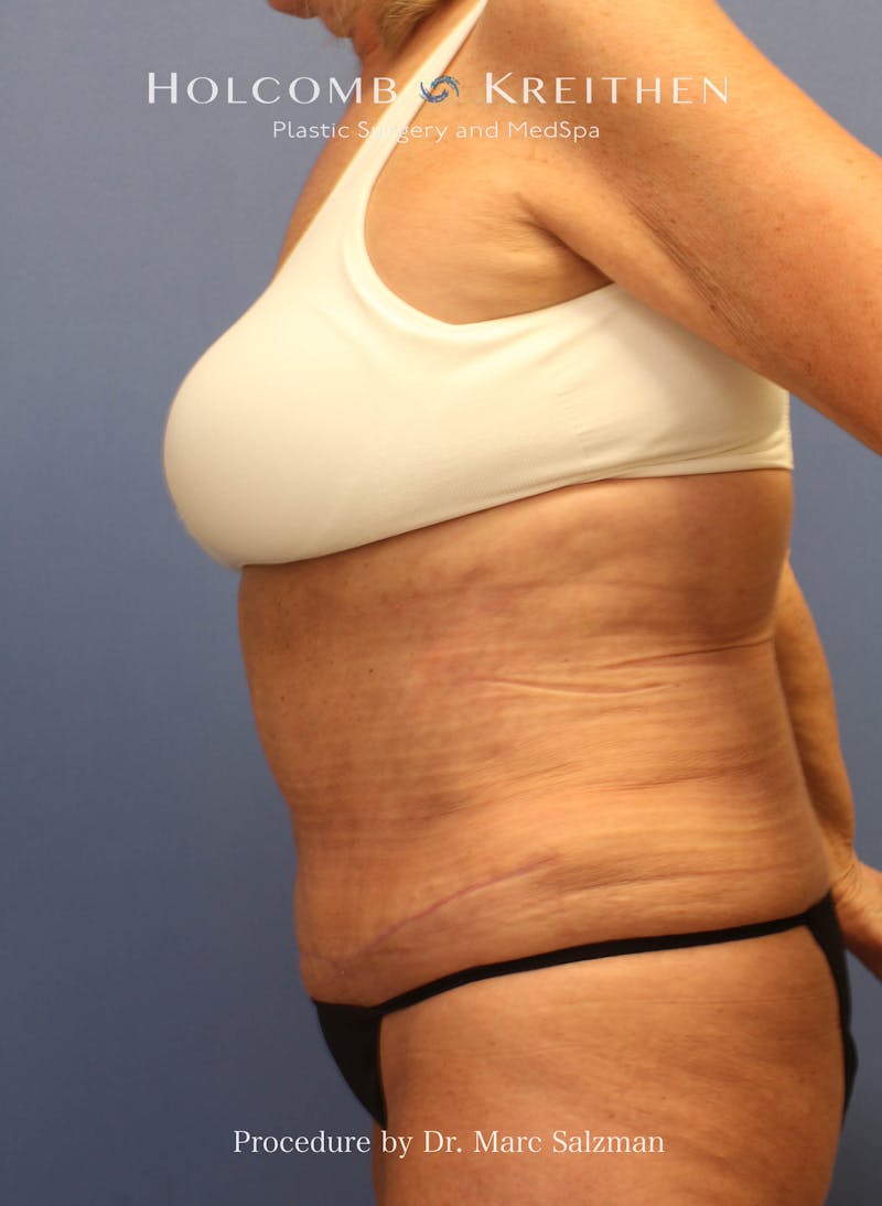 Tummy Tuck Before & After Gallery - Patient 416921 - Image 6