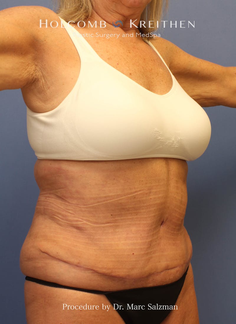 Tummy Tuck Before & After Gallery - Patient 416921 - Image 8
