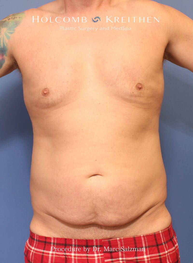 Tummy Tuck Before & After Gallery - Patient 378992 - Image 1