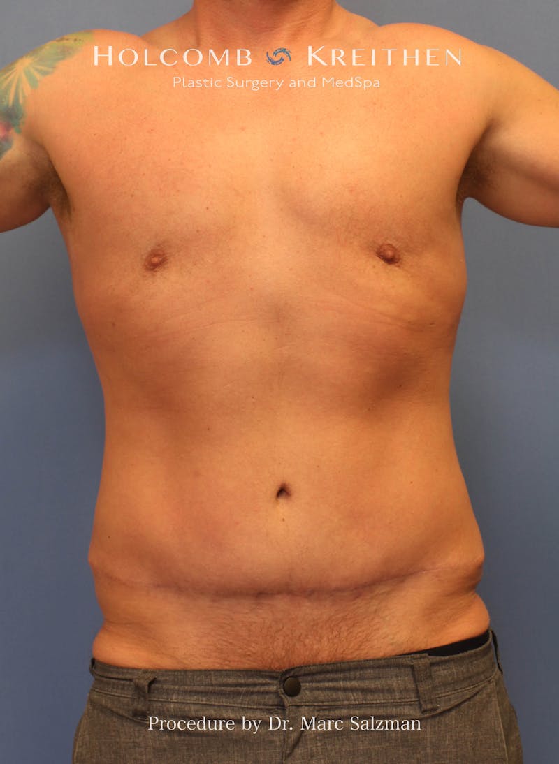 Tummy Tuck Before & After Gallery - Patient 378992 - Image 2