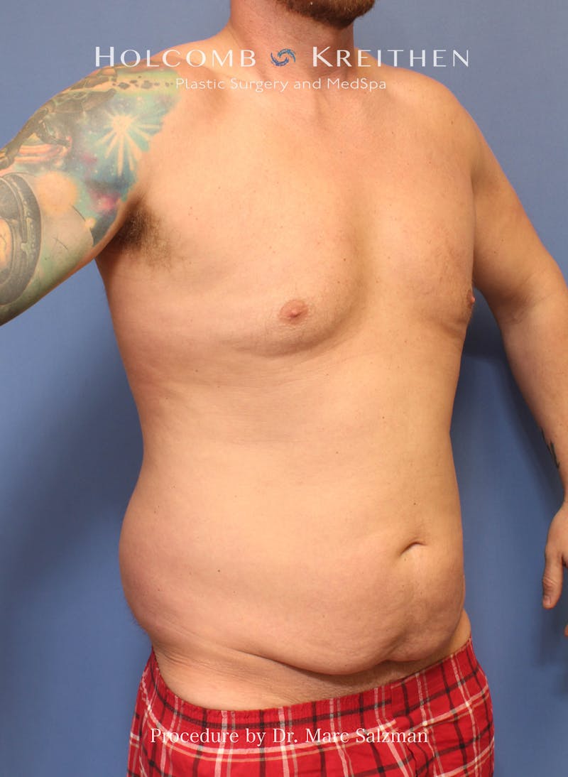 Tummy Tuck Before & After Gallery - Patient 378992 - Image 5