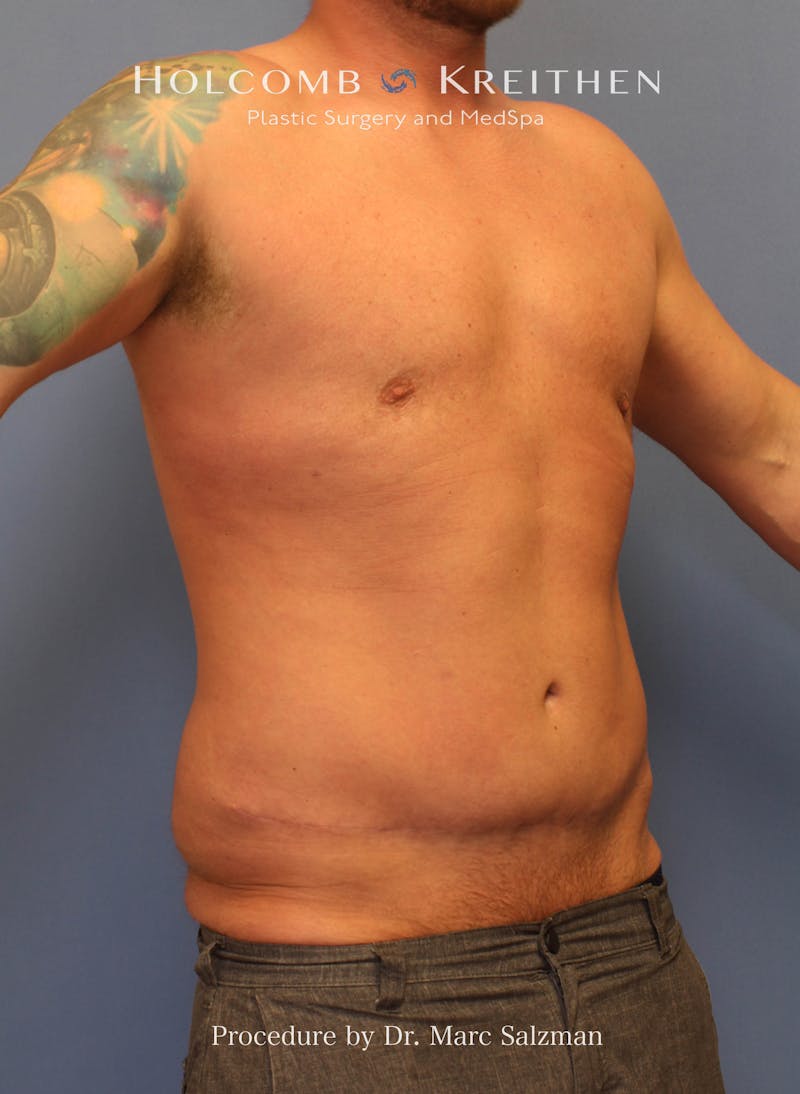 Tummy Tuck Before & After Gallery - Patient 378992 - Image 6