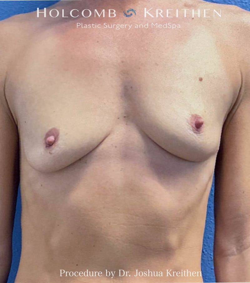 Breast Augmentation Before & After Gallery - Patient 168213 - Image 1