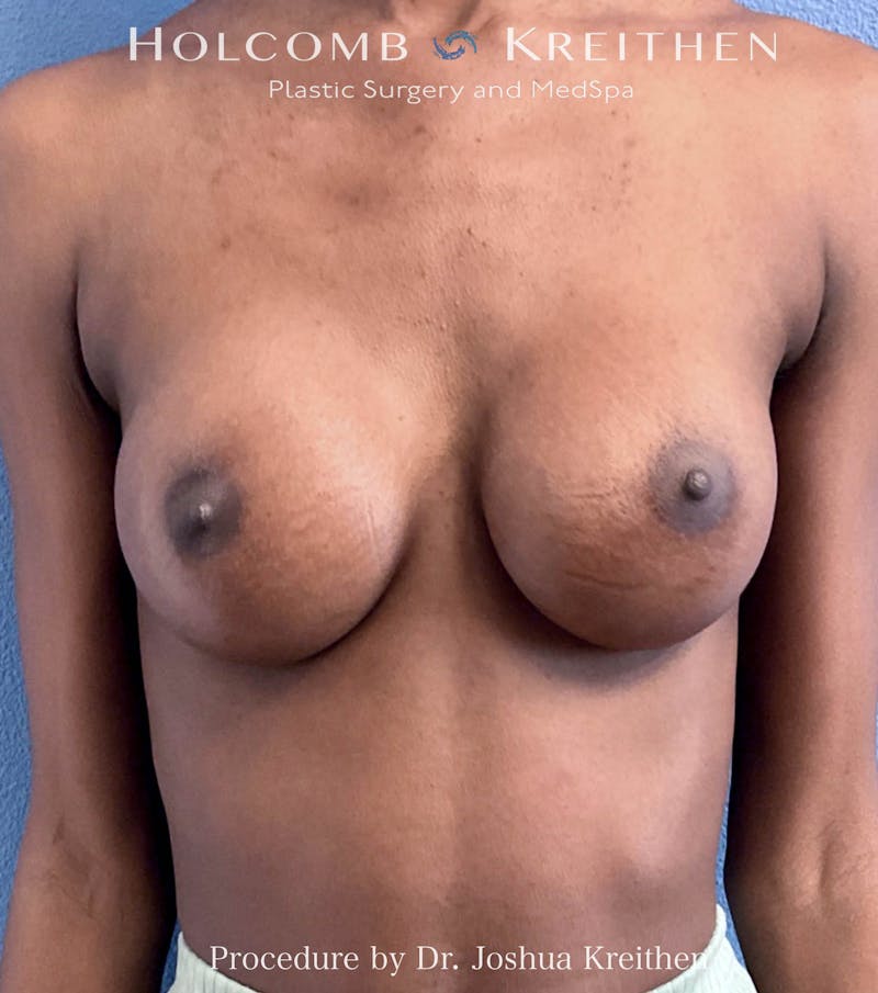 Breast Augmentation Before & After Gallery - Patient 197183 - Image 2