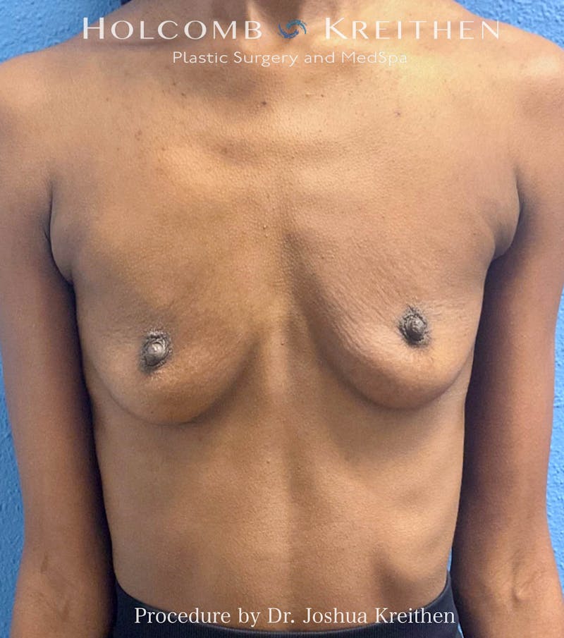 Breast Augmentation Before & After Gallery - Patient 197183 - Image 1