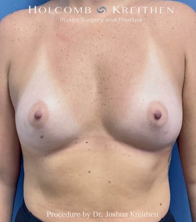 Breast Augmentation Before & After Gallery - Patient 225224 - Image 1