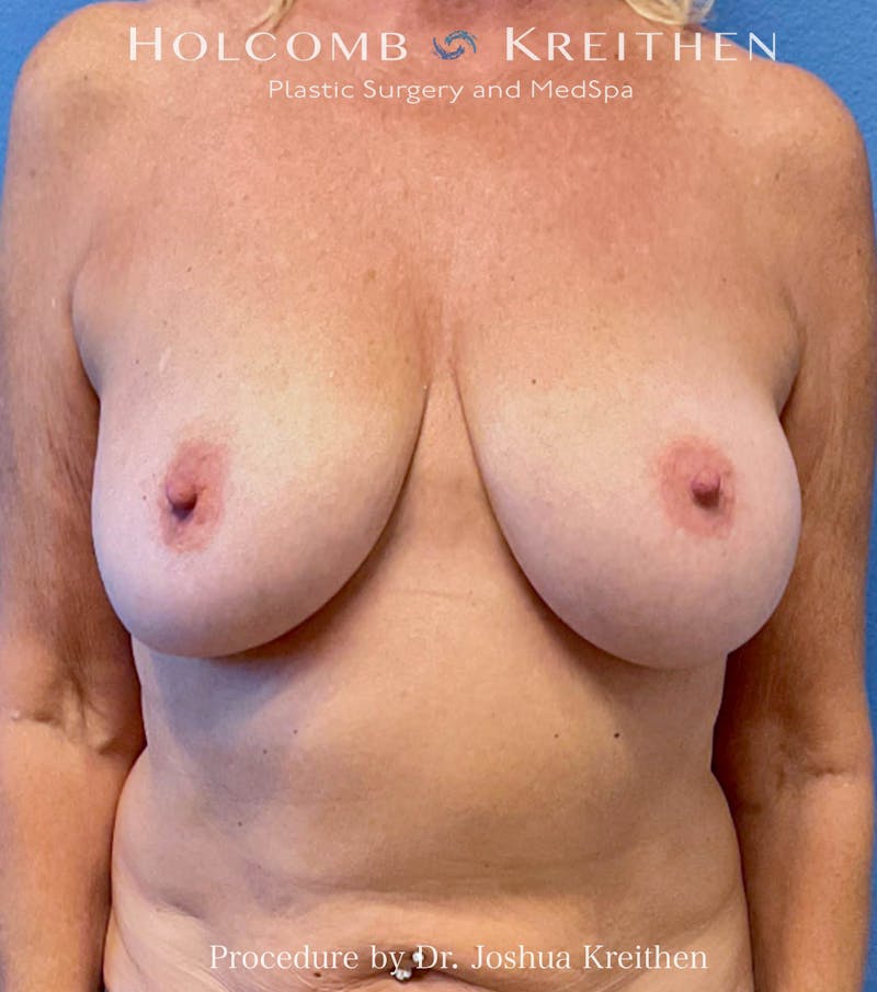 Breast Augmentation Before & After Gallery - Patient 101555 - Image 1