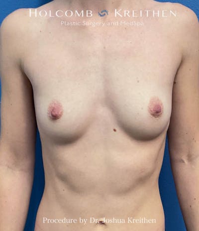 Breast Augmentation Before & After Gallery - Patient 381720 - Image 1