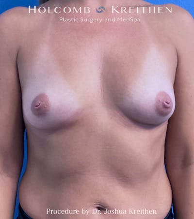 Breast Augmentation Before & After Gallery - Patient 716624 - Image 1