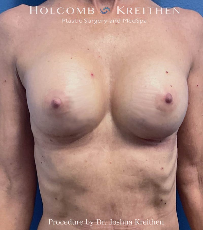 Breast Augmentation Before & After Gallery - Patient 125462 - Image 2