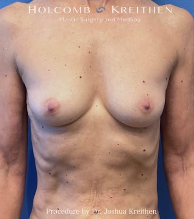 Breast Augmentation Before & After Gallery - Patient 125462 - Image 1