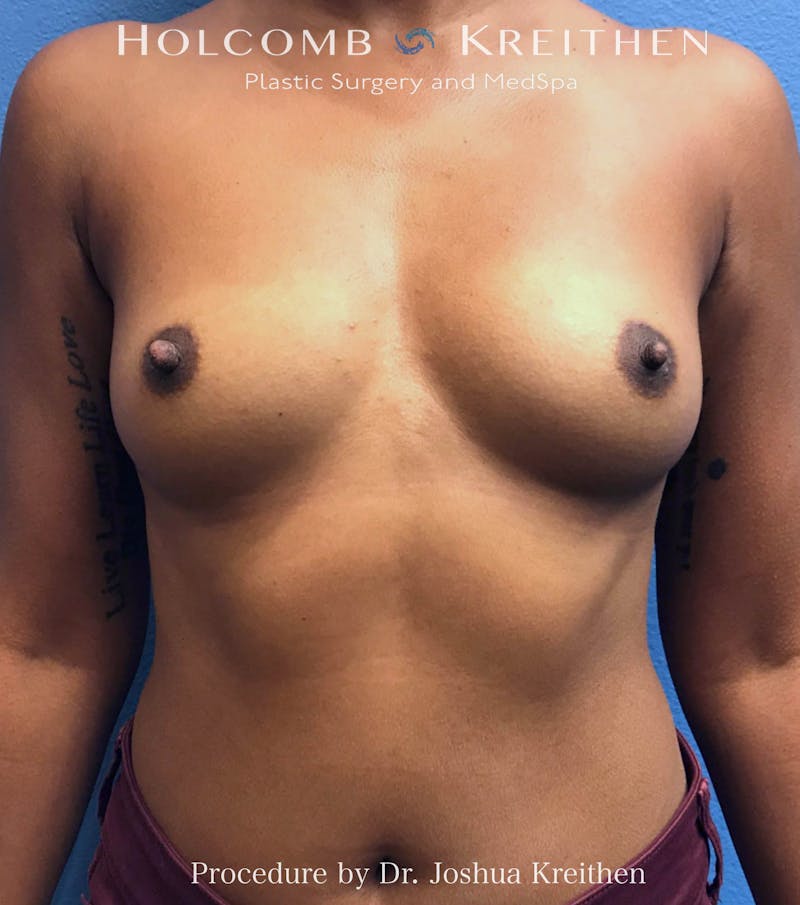 Breast Augmentation Before & After Gallery - Patient 288424 - Image 1