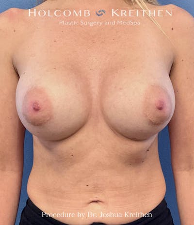Breast Augmentation Before & After Gallery - Patient 328876 - Image 2