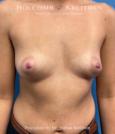 Breast Augmentation Before & After Gallery - Patient 328876 - Image 1