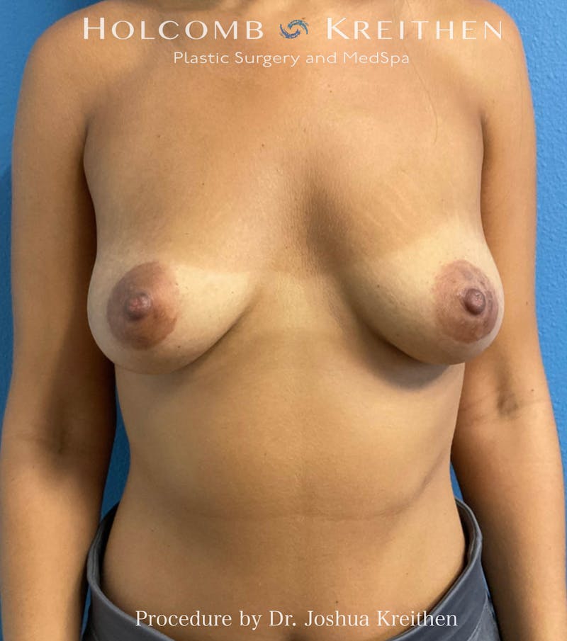 Breast Augmentation Before & After Gallery - Patient 236218 - Image 1