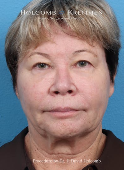 eCO2 Fractional Laser Before & After Gallery - Patient 393440 - Image 1