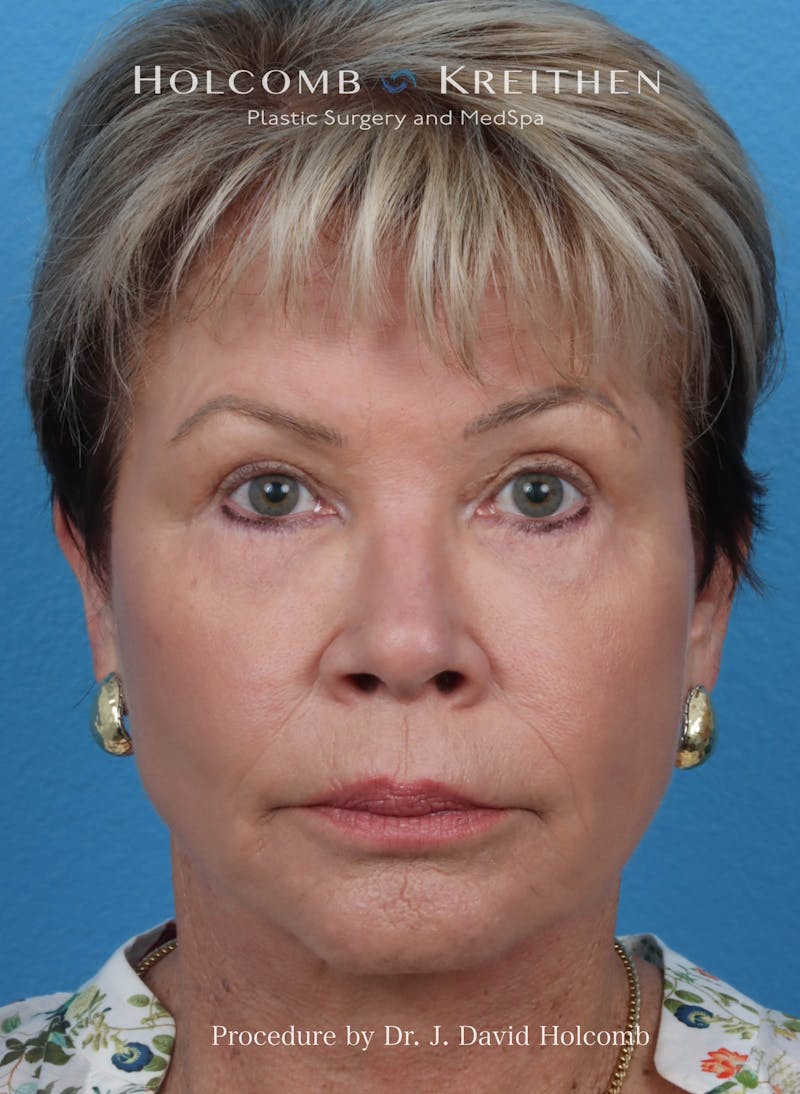 Facelift Before & After Gallery - Patient 409180 - Image 2
