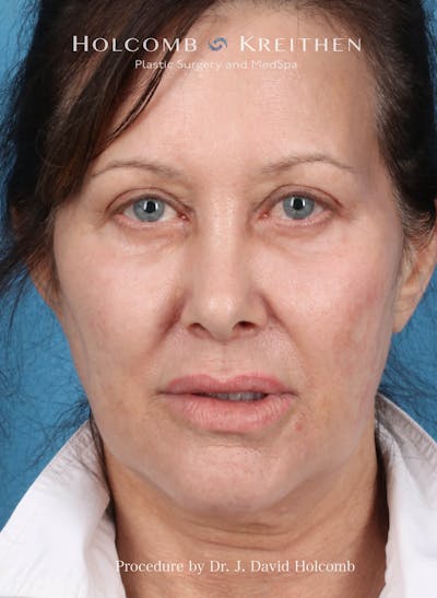 Browlift Before & After Gallery - Patient 194511 - Image 1
