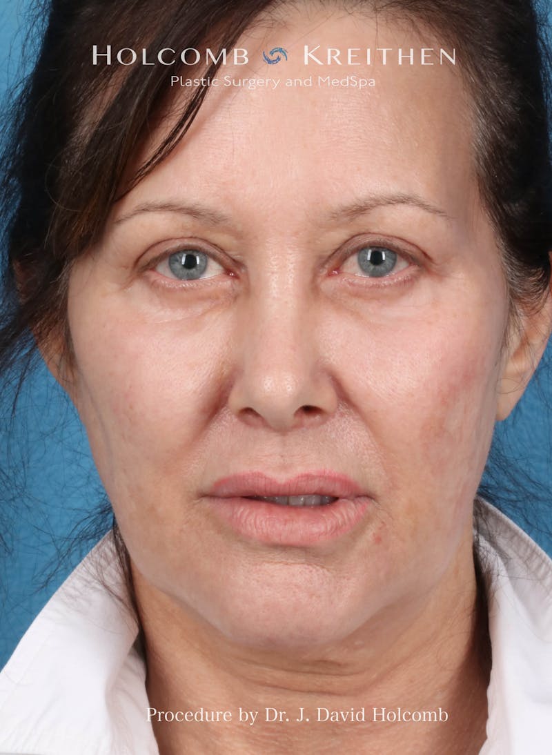 Facelift Before & After Gallery - Patient 126827 - Image 1