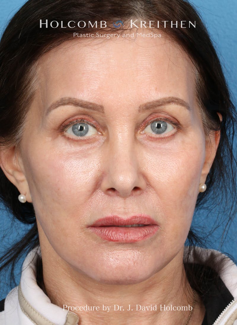 Facelift Before & After Gallery - Patient 126827 - Image 2