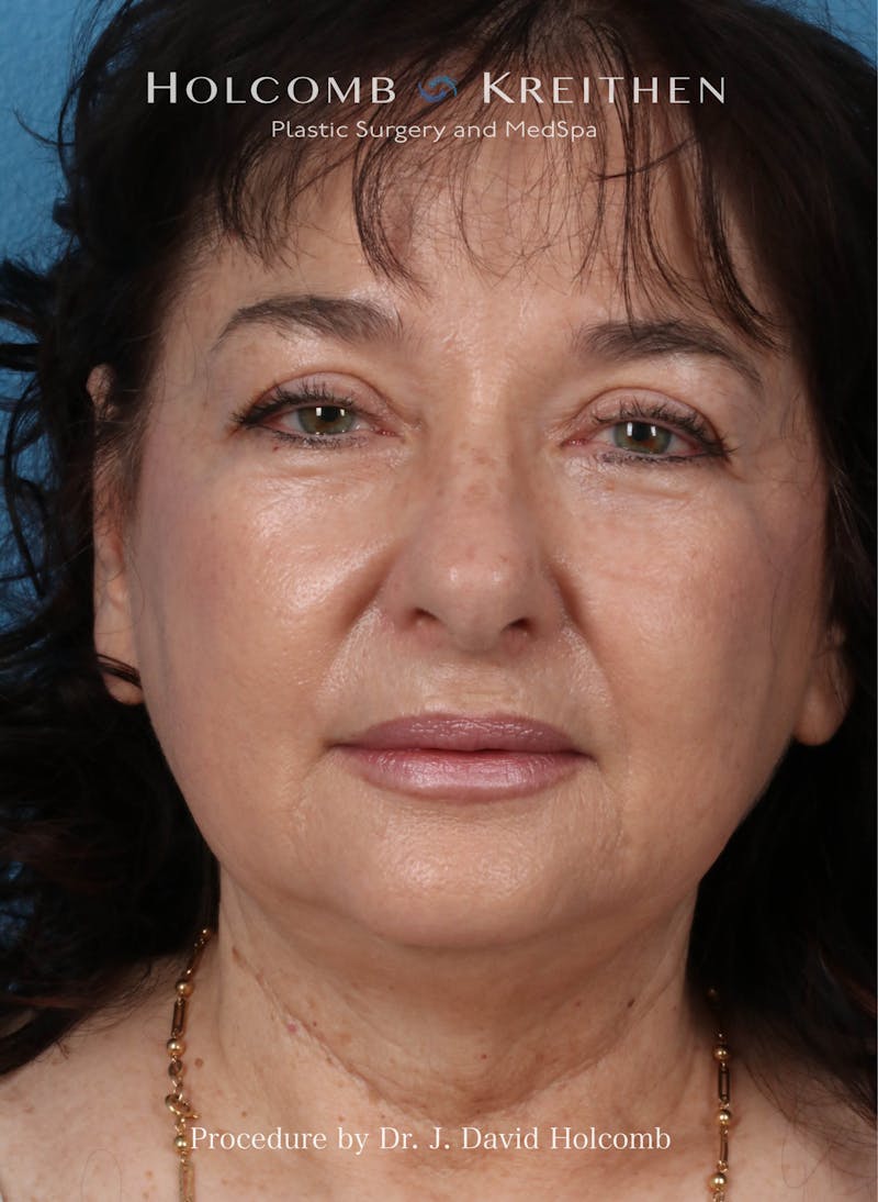 Browlift Before & After Gallery - Patient 177340 - Image 1