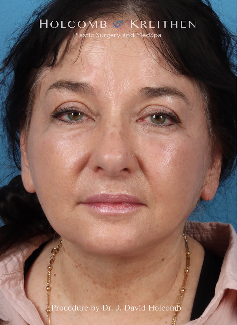 Browlift Before & After Gallery - Patient 177340 - Image 2