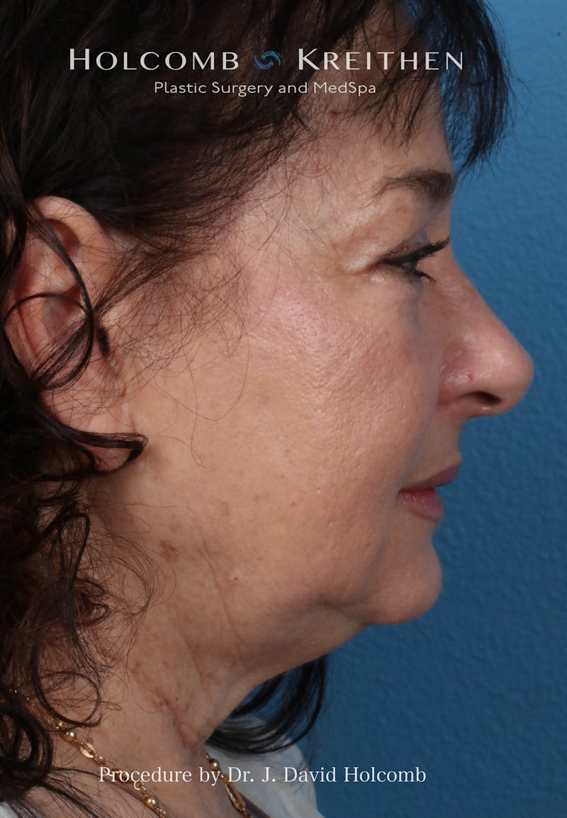 Browlift Before & After Gallery - Patient 177340 - Image 5