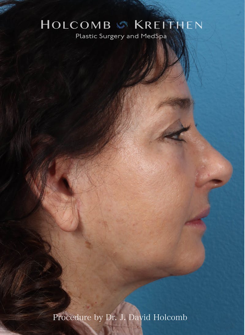 Browlift Before & After Gallery - Patient 177340 - Image 6