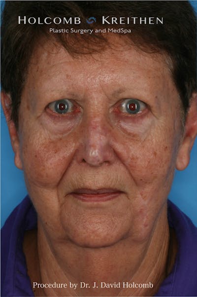 Browlift Before & After Gallery - Patient 350264 - Image 1