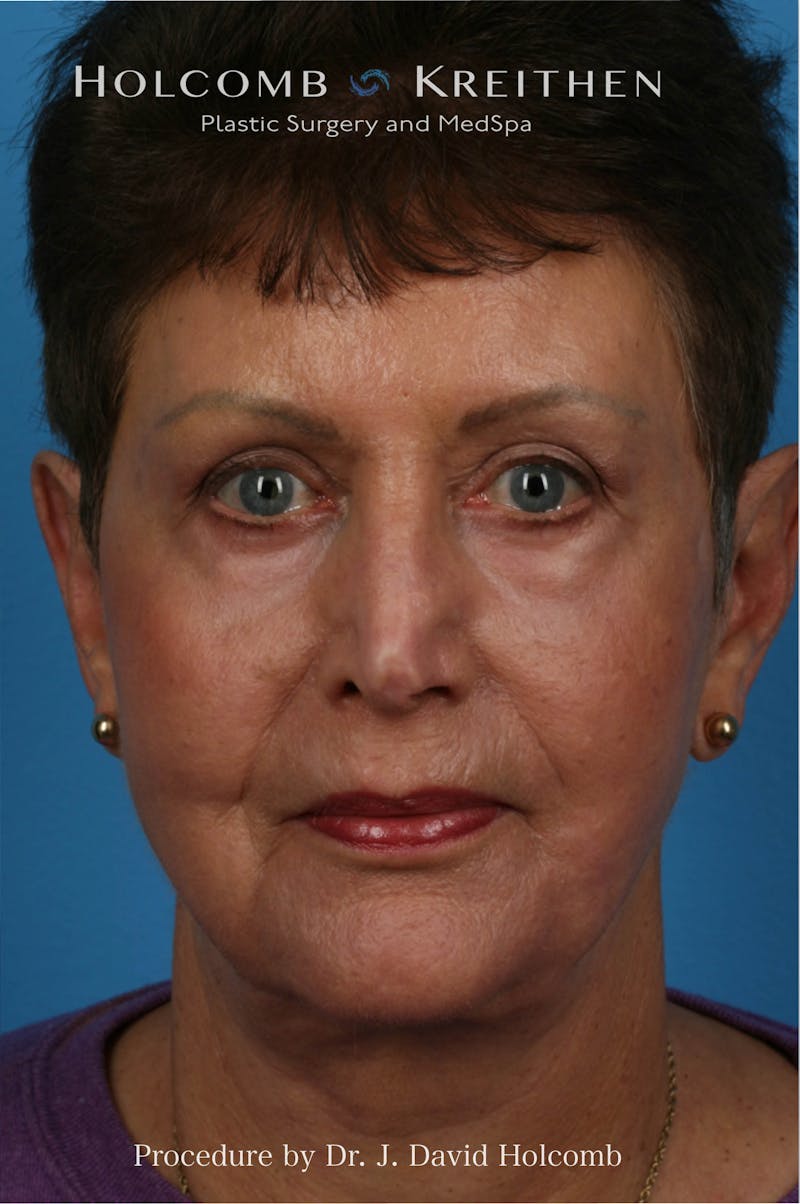 Facelift Before & After Gallery - Patient 184588 - Image 2