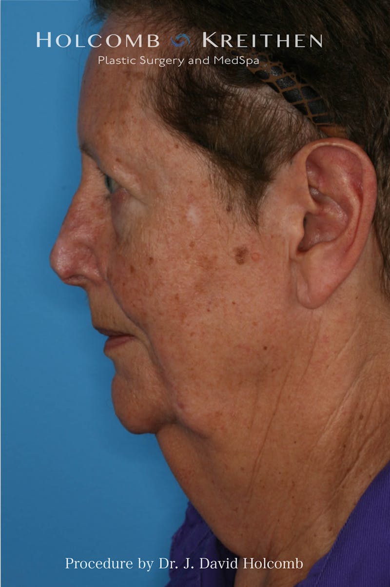 Facelift Before & After Gallery - Patient 184588 - Image 3