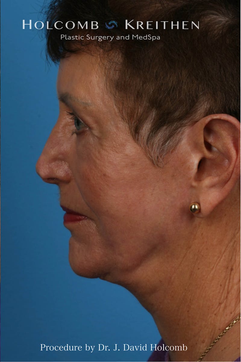 Facelift Before & After Gallery - Patient 184588 - Image 4