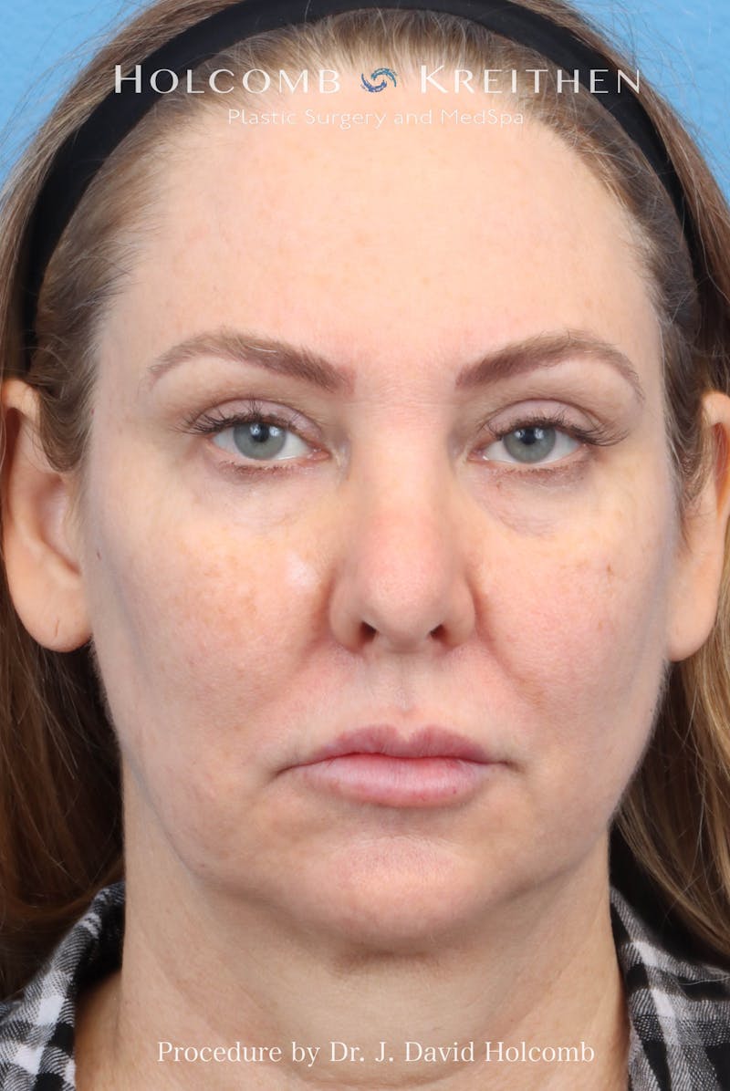 eCO2 Fractional Laser Before & After Gallery - Patient 193988 - Image 1