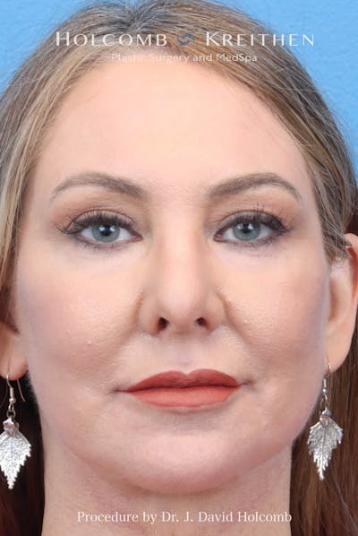 eCO2 Fractional Laser Before & After Gallery - Patient 193988 - Image 2
